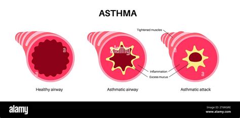 Bronchiole Asthma Hi Res Stock Photography And Images Alamy