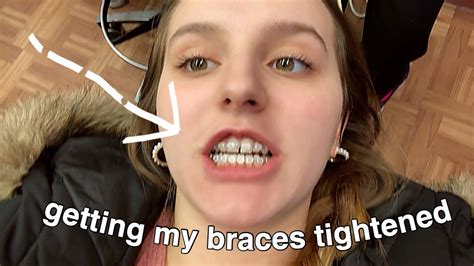 Getting My Braces Tightened For The First Time Answering Subscriber Questions Youtube