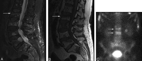 Acute Vertebral Compression Fractures In Patients With Multiple Myeloma