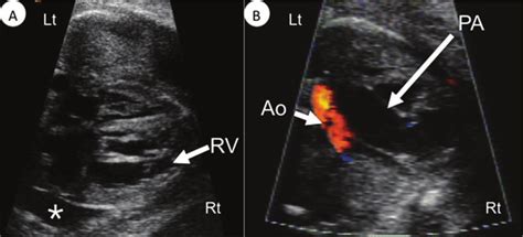 Fetal Echocardiography A Four Chamber View Pleural Effusion