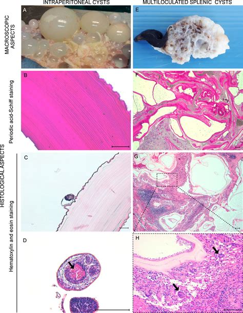 Gross And Histopathological Features Of Hydatid Cysts Free Peritoneal