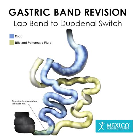 Lap Band Revision Surgery In Mexico Mexico Bariatric Center