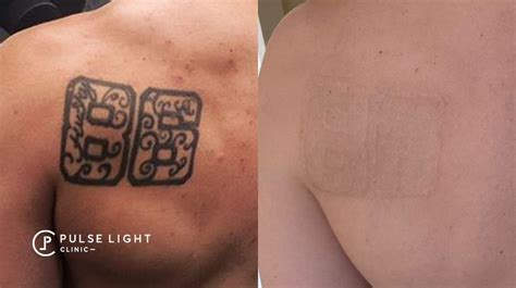 Các Phương Pháp Laser Tattoo Removal An Toàn Và Hiệu Quả Nhất Hiện Nay