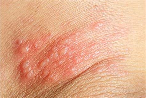Butt Skin Conditions And Rashes Causes And Treatment Sghcairo Net