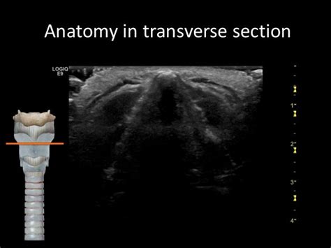 Airway Ultrasound