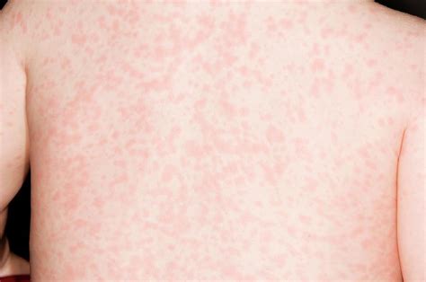 Measles Rash On The Back Photograph By Dr P Marazzi