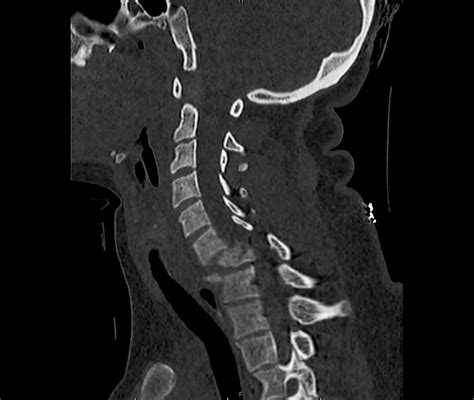 Differential Diagnosis Of Cervical Spine Injuries