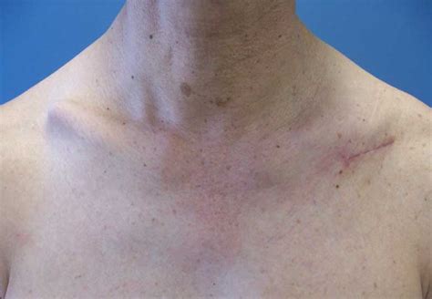 Clavicle Fracture Surgery Dr David Duckworth