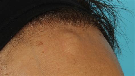 A Swuishy Lump In The Middle Of My Forehead Lasopaport