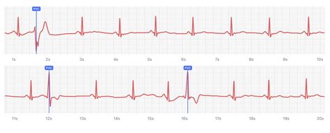 Qaly What Heart Palpitations And Ectopic Beats Look Like On Your