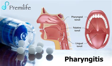 Pharyngitis Premilife Homeopathic Remedies