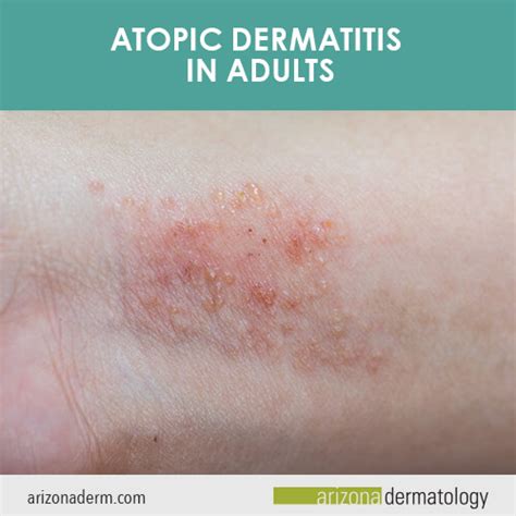 5 Things To You Need To Know About Atopic Dermatitis In Adults