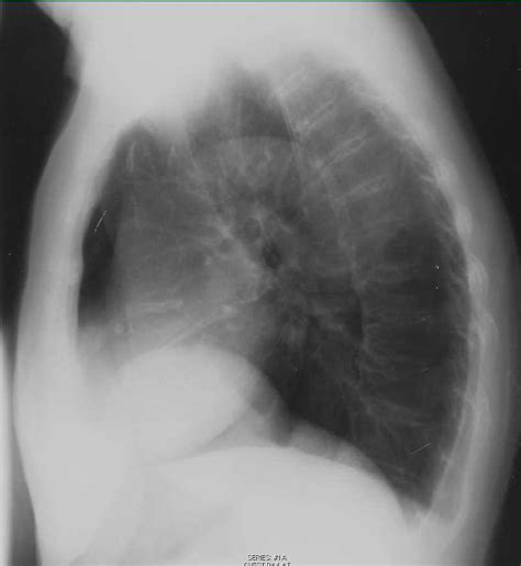 Coronary Calcification On Chest X Ray X Rays Case Studies Ctisus Ct
