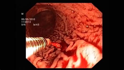 Bleeding may occur anywhere along the digestive (gastrointestinal gi) tract, from the mouth to the anus. Endoscopy in GI bleeding - YouTube