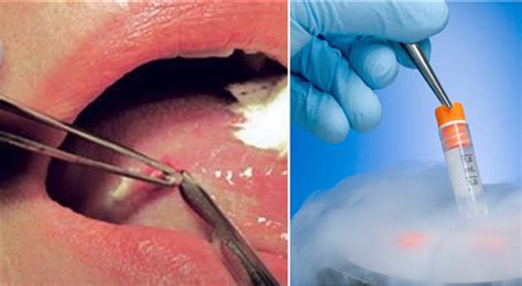 Oral Biopsy Dentist In Kolkata Avant Dental