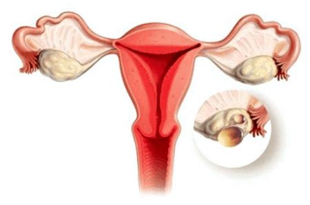 Éclatement du kyste ovarien symptômes premiers soins et traitement