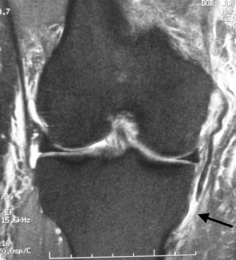 Coronal Mri Demonstrating Complete Grade 3 Mcl Tear From The Tibial