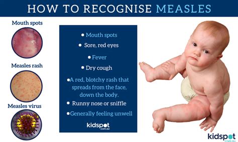 Measles What To Look For And What To Know Kidspot
