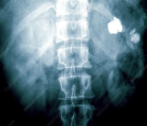 Kidney Stone X Ray Stock Image M1950088 Science Photo Library