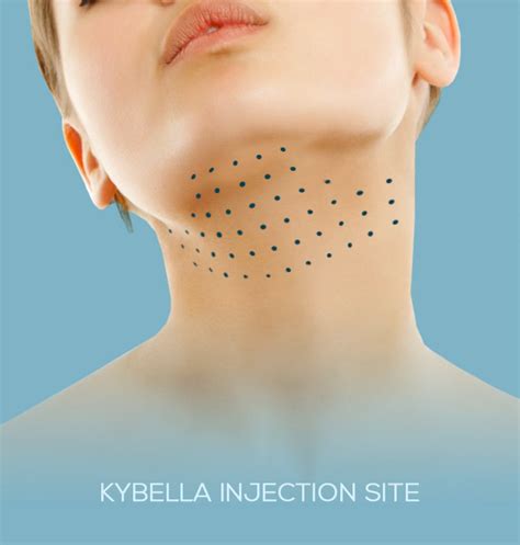 Ideal Candidates For Kybella ® Are Adults Aged 18 Or Older In Otherwise