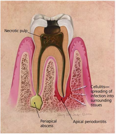 Pediatric Sepsis Secondary To An Occult Dental Abscess A Case Report