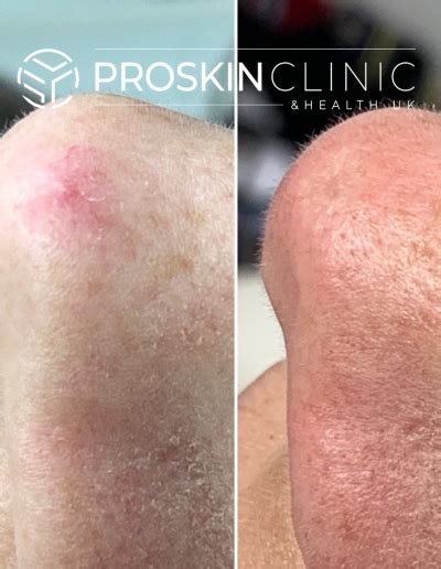 Blood Spot Removal Proskin Clinic And Health Uk Skin Tag Removal