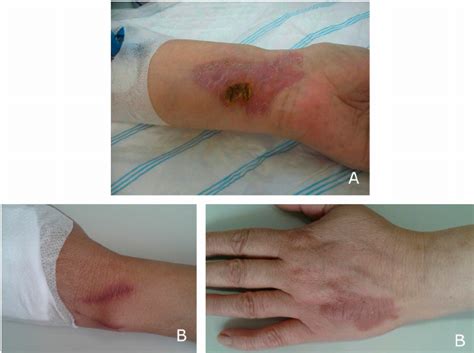 Observed Skin Toxicities A Lesions With A Purplish Red Rash 24 72 H