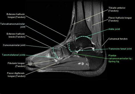 A magnetic resonance imaging (mri) was performed on a normal subject; MRI ankle. Unidad Especializada en Ortopedia y ...