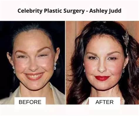 Celebrity Plastic Surgery Before And After Images Fabbon