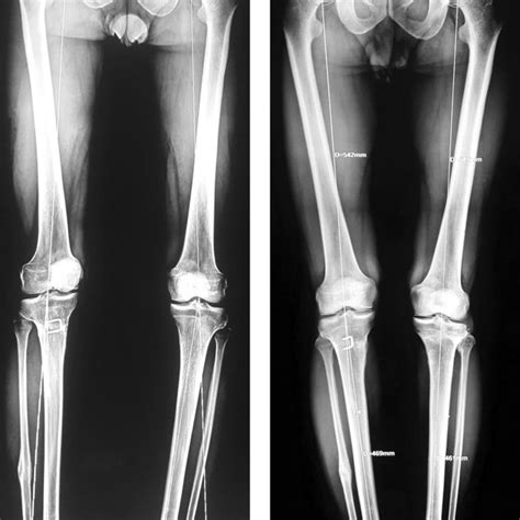Twenty Year Old Male 13 Months After Closing Wedge High Tibial