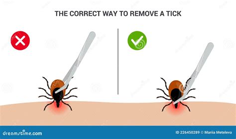 The Correct Way To Remove A Tick Insect Correctly Tips For Tick Safety
