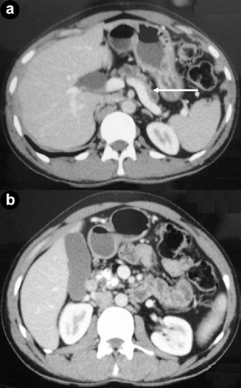 Ct Showing Atrophic Pancreas With A Dilated 1 Cm Pancreatic Duct A