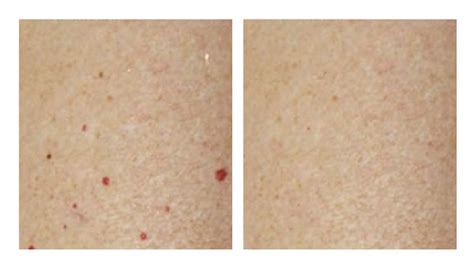 Blood Spot Removal Services Renew Skin Clinic