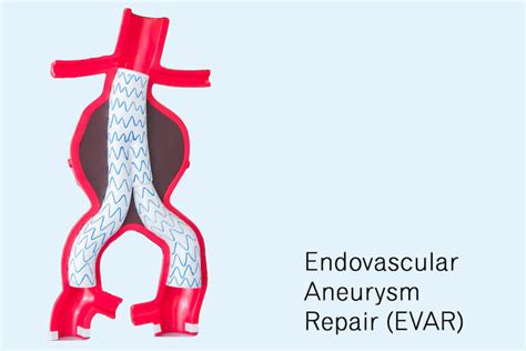Understanding The Basics Of Aneurysms — Vascular Surgery Specialist