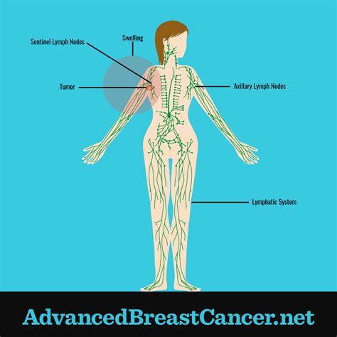 What Is Lymphedema In Metastatic Breast Cancer