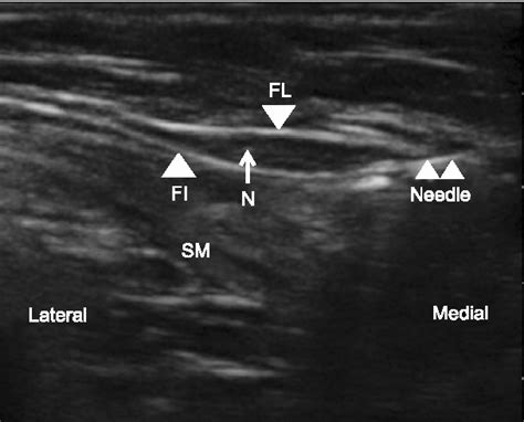 Figure 2 From Ultrasound Guided Lateral Femoral Cutaneous Nerve Block