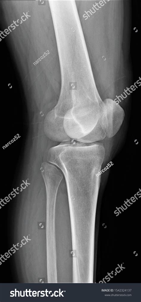 Normal Radiography Knee Joint Lateral Projection Stock Photo