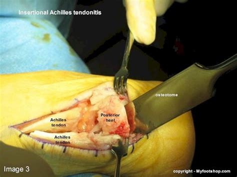 The achilles tendon is a fibrous band of tissue that links the muscles in your calf to your heel. Achilles Tendinitis | Causes and treatment options ...