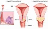 Images of Cervical Cancer During Pregnancy Treatment