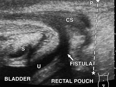 Transperineal Sonography For Determination Of The Type Of Imperforate
