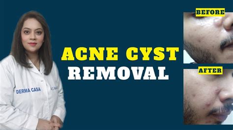 Acne Cyst Removal And Treatment Home Remedies For Cystic Acne Youtube