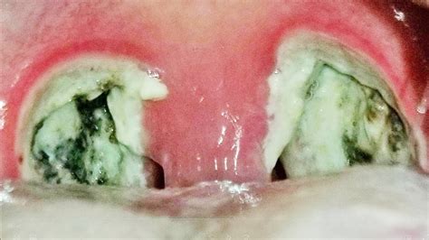 What Are Tonsil Stones What Causes Mucus Balls In Back Of Throat