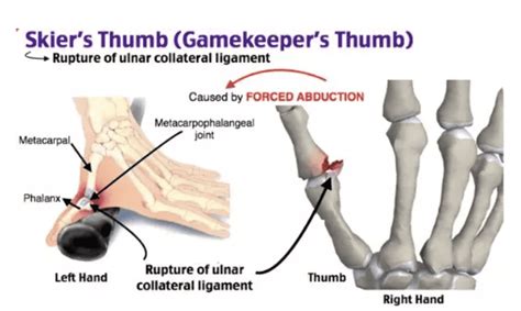 Ulnar Collateral Ligament Injury Skiers Thumb Teton Hand Surgery
