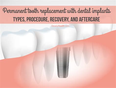 This is a pvt.franchise.he tries to help people especially seniors who medically need implant dentures due to tooth loss, aging, bone loss.it cost me right around 10,600 to have 12 extractions, 5 implants, snap. Permanent Tooth Replacement With Dental Implants: Types ...