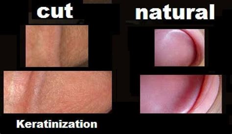 Big Difference Natural Vs Unnatural Look At How The Circumcised One Has Become Calloused