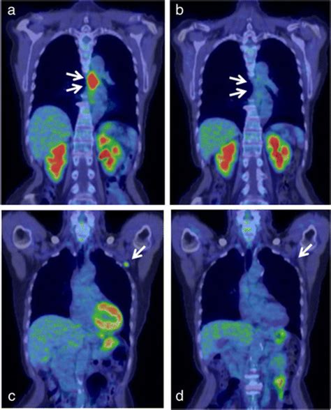 Positron Emission Tomographycomputed Tomography Petct Findings A