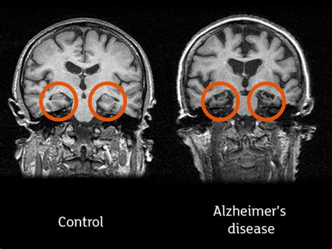 All You Need To Know About Brain Scans And Dementia Alzheimer S