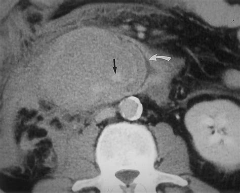 Ct Of The Duodenum An Overlooked Segment Gets Its Due Radiographics