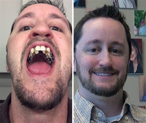 10 Incredible Before And After Transformations Of People Who Wore Braces