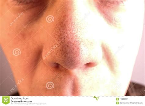 A Man With Big Pores And Blackheads On His Nose Stock Photo Image Of
